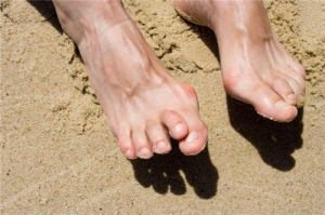 Men with Bunions