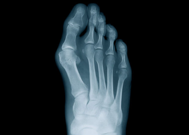 bunions feat