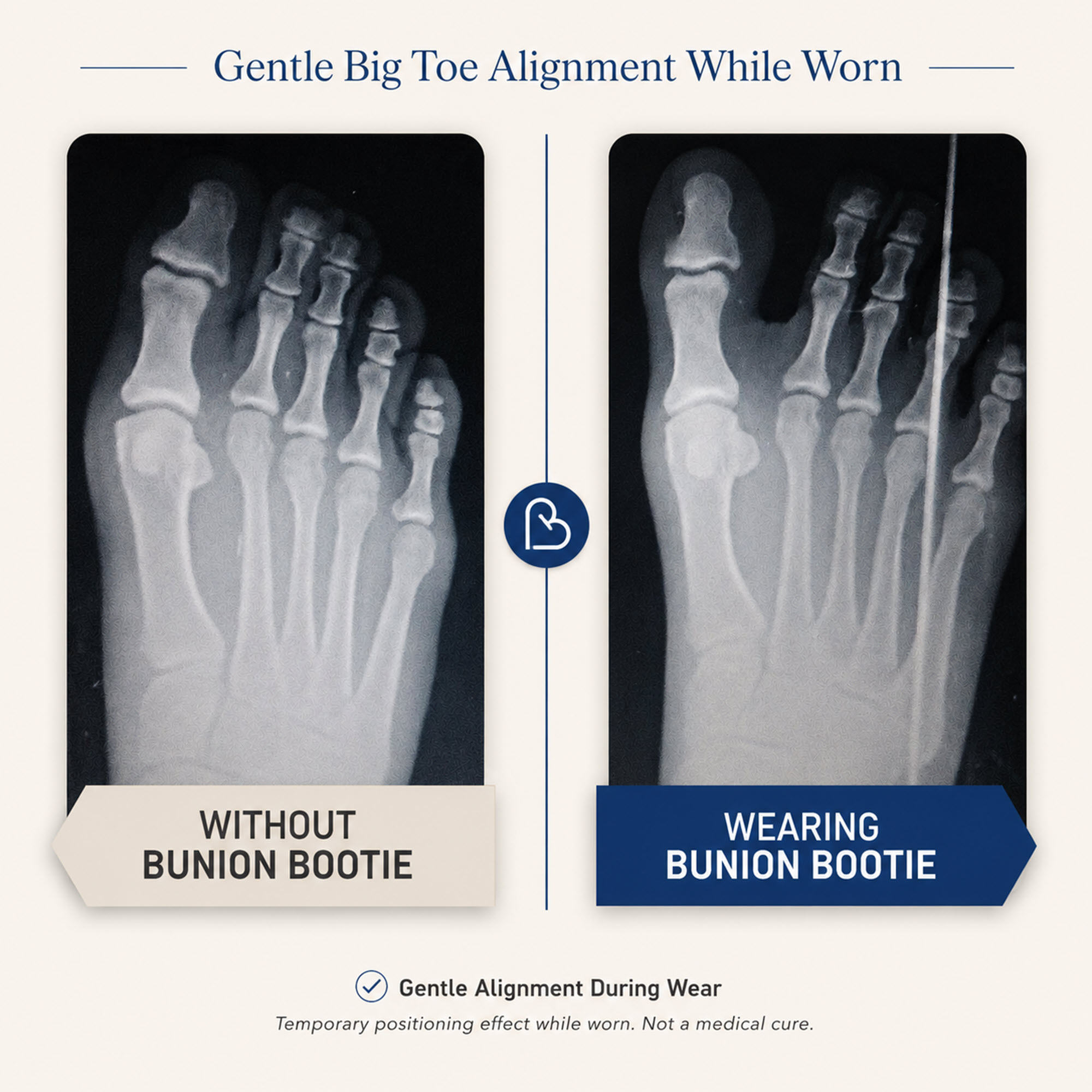 X-Ray Bunion Corrector Big Toe Straightener