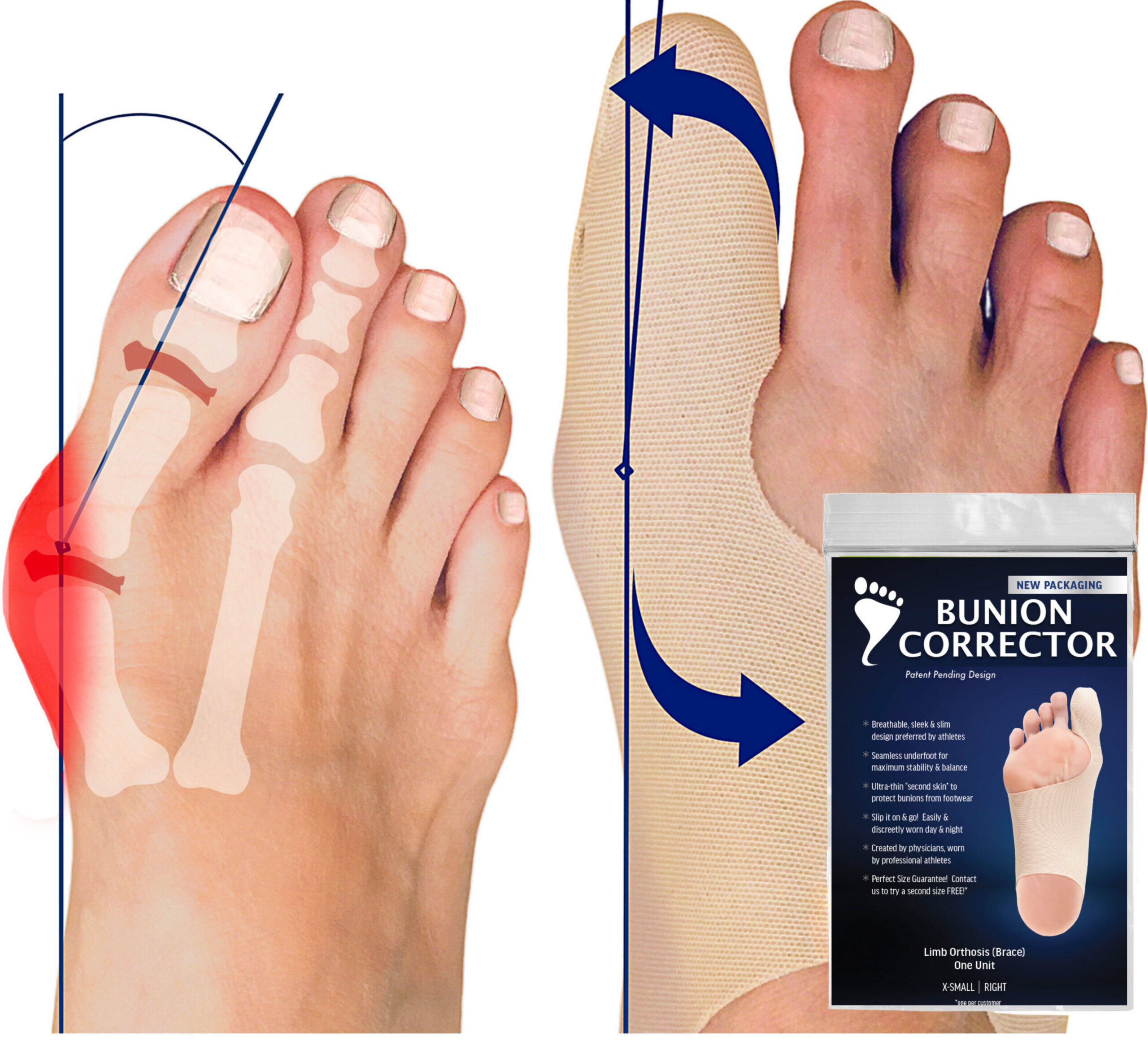 Bunion Bootie toe alignment