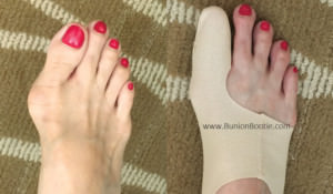 Bunion Bootie Before After