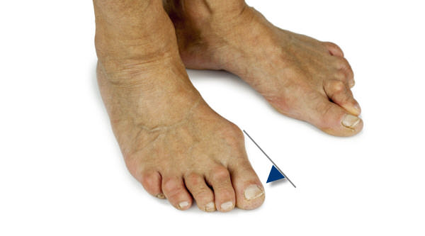 Man with bunion