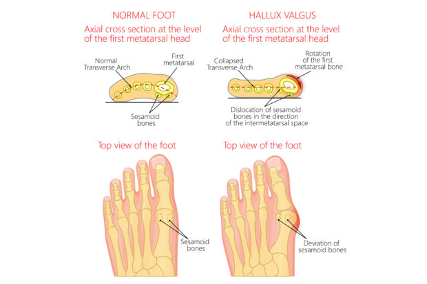 hallux valugs vs hallux rigidus