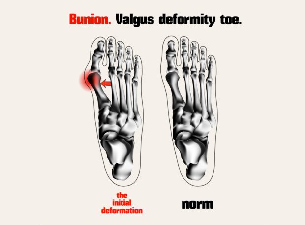 Prevention Bunion Treatment