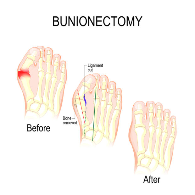 Osteotomy Bunion Treatment Surgery