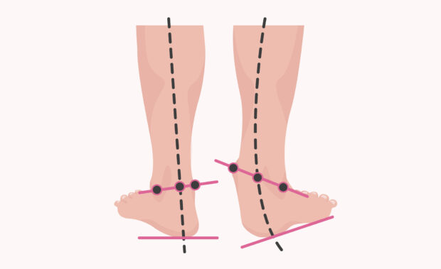 bunions impact on body alignment