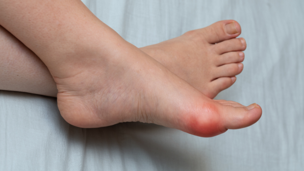 How to Stop Bunion Rubbing for Good
